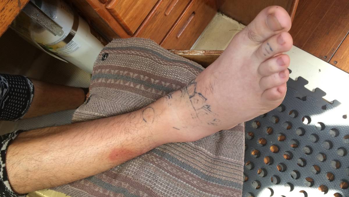 devine with a swollen ankle due to wasp bite